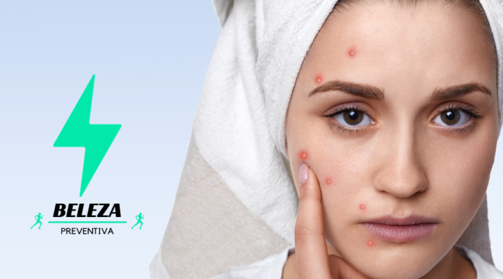COMO TRATAR ACNES E ESPINHAS NO ROSTO